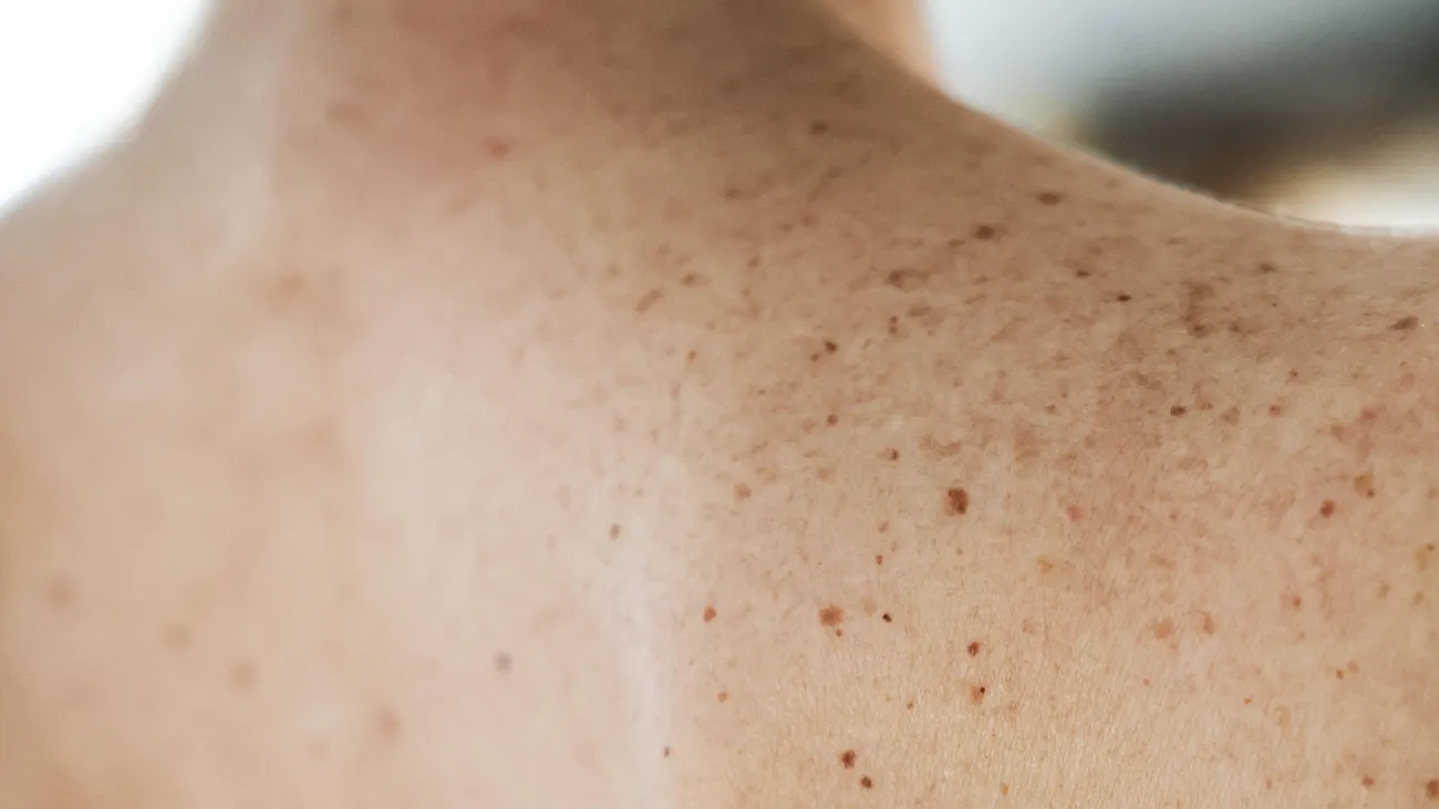 Moderna công bố kết quả tích cực từ vaccine mRNA chống ung thư da
